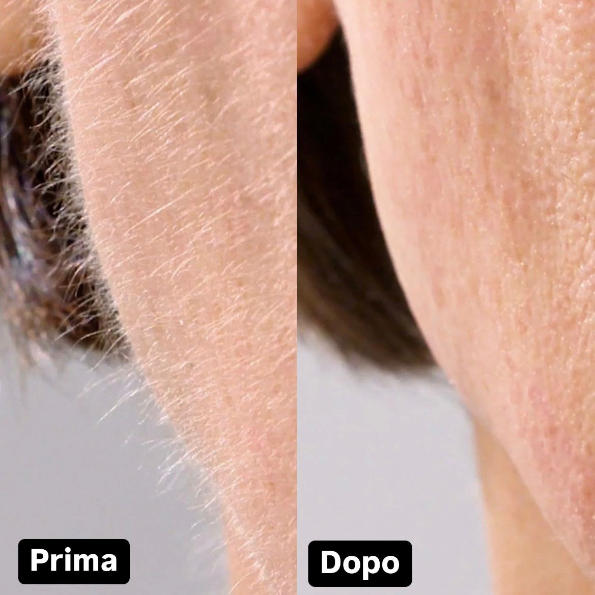6 Testine Di Ricambio Aggiuntive - Dermajoule